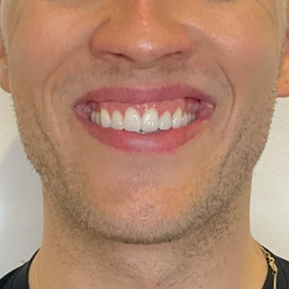 CeriX-Tandkødssmil-før