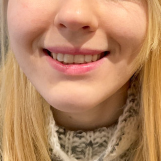 CeriX-website-lipflip-gummismile-efter