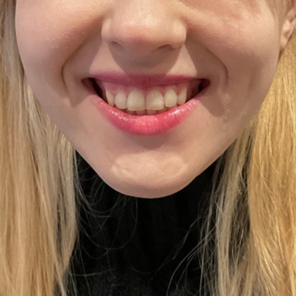 CeriX-website-lipflip-gummismile-før