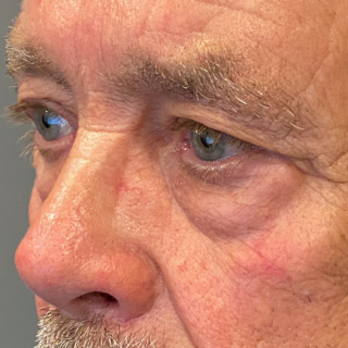 cerix-website-øjenlåg-nedre-øvre-før1