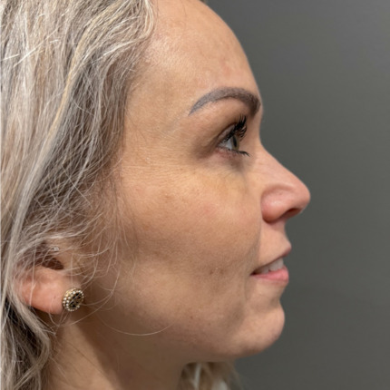 CeriX-Website-ipl-2-behandlinger-efter