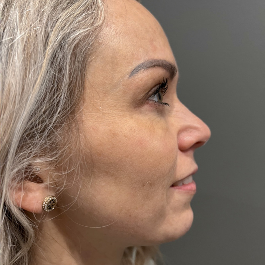 CeriX-Website-ipl-2-behandlinger-efter