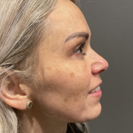 CeriX-Website-ipl-2-behandlinger-før