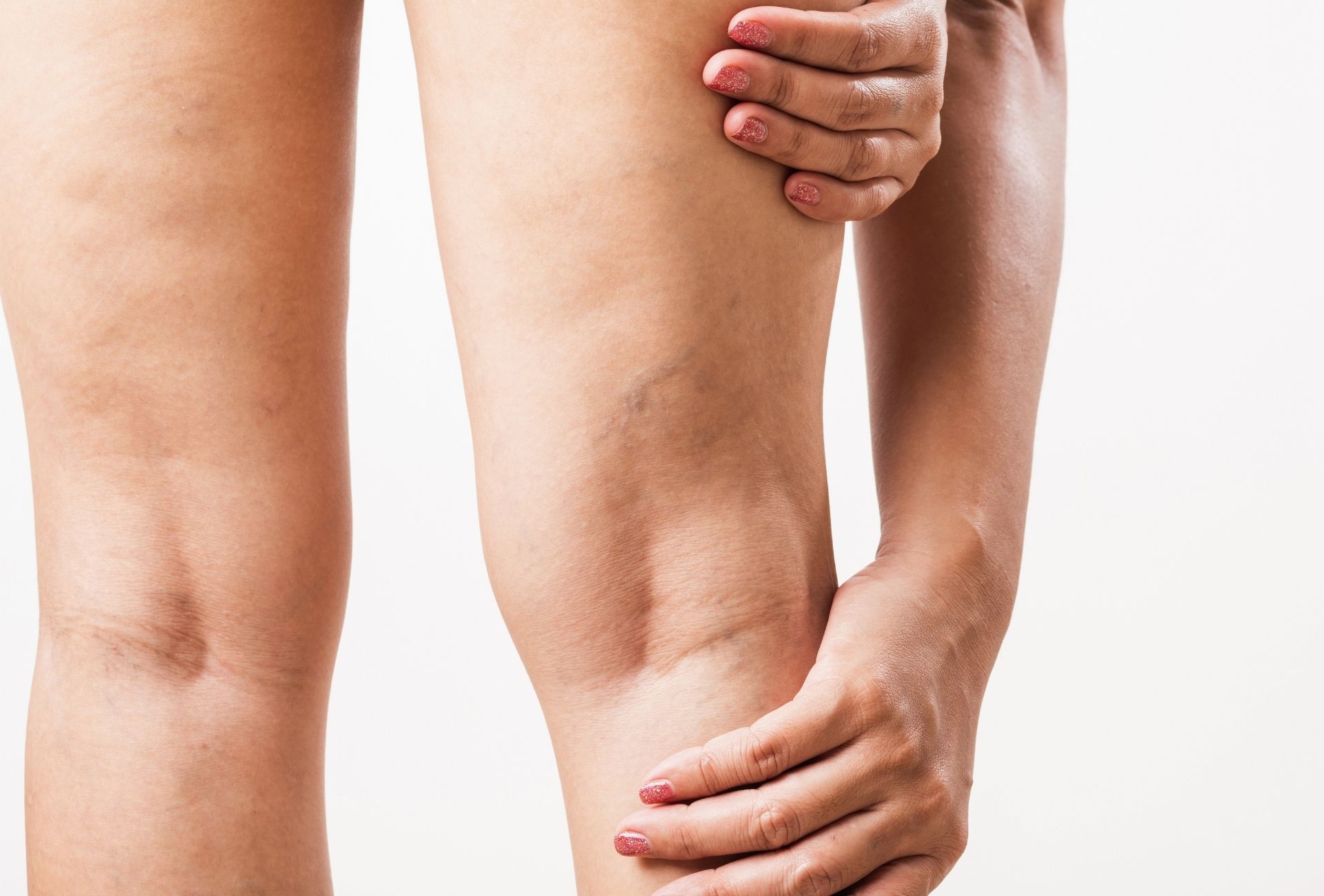 Nærbillede af en kvindes lår og knæ bagfra, med hænder, der holder benet. Billedet viser synlige små blodkar/åreknuder, let cellulite og hudstruktur. Cerix tilbyder åreknudebehandling på ben/lår, fx scleroterapi eller laser, for forbedret hududseende og reduktion af synlige kar og ujævnheder.