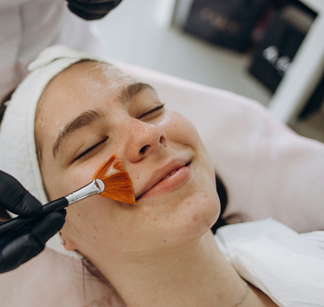 melasma-og-cosmelan-peeling-image1 1