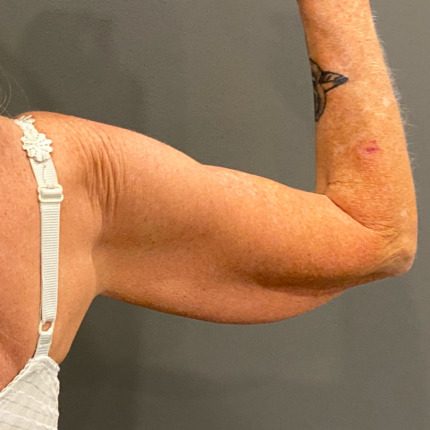 Cerix: Foto af en let bøjet overarm (arm) med løs hud, rynker og aldersrelateret pigmentering, synlig tatovering ved albuen og hvid bh-strop, med tydelig hudtekstur, små ar og neutral grå baggrund. Typisk konsultationsbillede til armplastik/armløft behandling hos Cerix, der viser tricepsområdet og hudoverskud før indgreb.