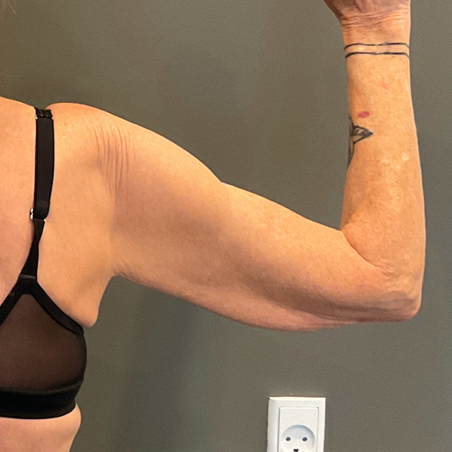 Cerix: Foto i sideprofil af højre overarm og skulder på en patient i sort bh, arm bøjet så løs hud, rynker og tatovering er synlig. Billedet fungerer som førbillede til overarmsløft (armplastik) og viser fokus på overarmens form og hudkvalitet.