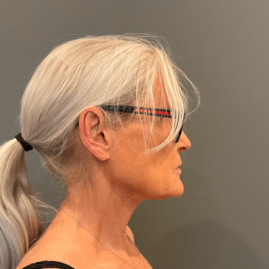 Profilfoto af moden kvinde med sølvgråt hår samlet i hestehale, iført sorte briller. Billedet fremhæver ansigtets profil, kæbelinje og hals i et sidefoto taget i klinisk miljø. Cerix – eksempel på ansigtsbehandling som Botox eller ansigtsløft, brugt til vurdering af hudens struktur og kontur.