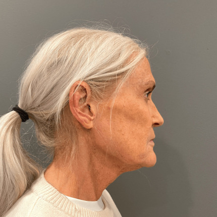 Profilbillede af en kvinde med sølvgråt hår i hestehale, set mod grå baggrund; billedet fokuserer på ansigt og hals. Cerix viser kandidat til ansigtsløft/halsløft (ansigt og hals) med tydelig kæbelinje og løs hud, relevant for facelift eller Botox-behandling til forbedring og foryngelse.