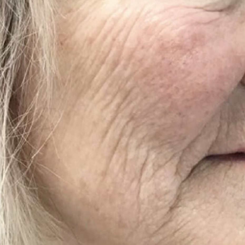 Nærbillede af en ældre persons underansigt og hals med dybe rynker, slap hud og fine linjer langs kæbelinjen. Cerix tilbyder behandlinger som Botox og filler til ansigt og hals, og billedet illustrerer området før anti-rynke behandling, som eksempel på aldringens tekstur og rynkedannelse.