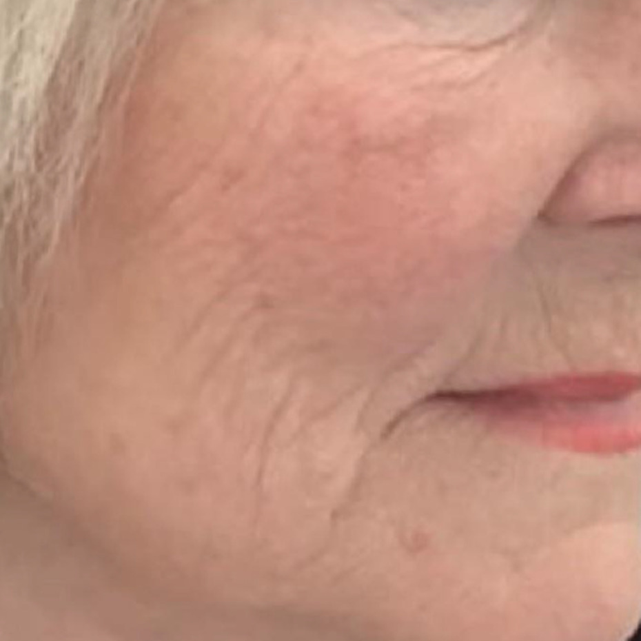 Nærbillede af nedre ansigt og kind med fine rynker, folder ved mundvigen og aldrende hud. Billedet bruges af Cerix som eksempel på ansigtsbehandlinger (Botox, filler eller ansigtsløft) til reduktion af rynker og forbedring af hudens struktur og elasticitet.