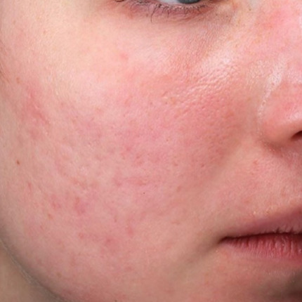 Cerix: Nærbillede af en persons kind og nederste ansigt med rødme, porer og ujævn hudtekstur fra akne og ar. Billedet illustrerer behov for ansigtsbehandling hos Cerix, fx acnebehandling, laser eller microneedling. Målet er at reducere ar, rødme og forbedre hudens struktur.