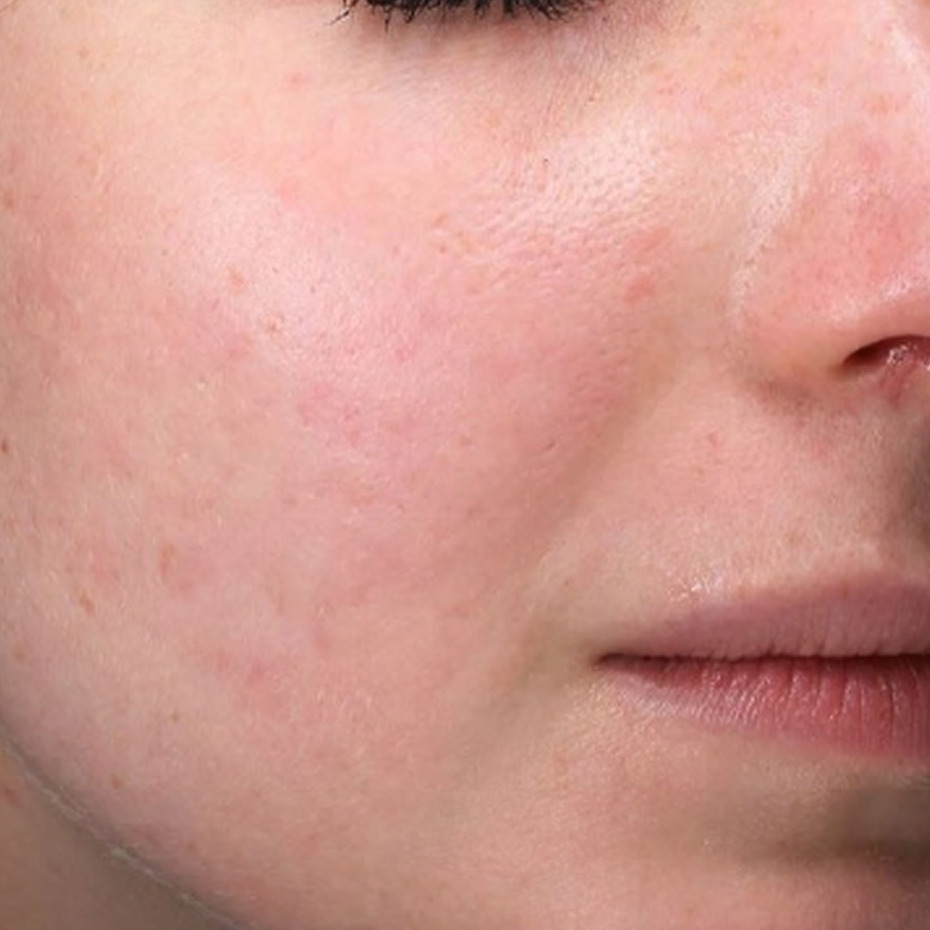 Nærbillede af venstre kind og mundområde på ansigtet med ujævn hudstruktur, synlige porer, rødme og lette aknear. Foto viser hudens tilstand omkring næse og kind før behandling. Cerix tilbyder ansigtsbehandling, her microneedling, rettet mod forbedring af hudstruktur og ar og ujævn pigmentering.
