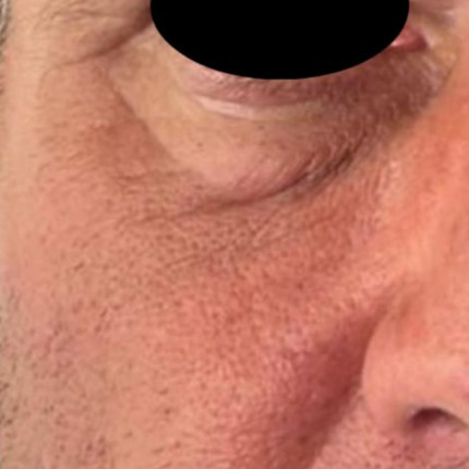 Cerix klinik: Nærbillede af højre side af ansigtet omkring øjet med synlige rynker, kragetæer, tør hud, forstørrede porer og let rødme; øjet er sorteret fra. Billedet illustrerer et typisk område til Botox-behandling mod kragetæer og fine linjer i ansigtet hos voksne patienter.