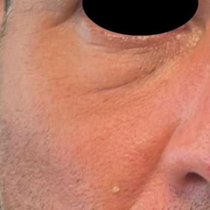 Cerix viser et nærbillede af højre ansigtsside med fokus på øjenområdet, underøjenposer, smilerynker, kind og næseryg. Billedet dokumenterer hudtekstur, porer, fine linjer, synlige rynker, let rødme og en lille hudplet — velegnet som eksempel på Botox-behandling af ansigtets rynker omkring øjnene.