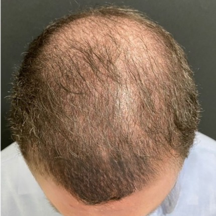 Billede set ovenfra af en mands hovedbund, der viser tegn på fremskredet hårtab og tyndt hår på issen. Hos Cerix tilbydes effektive behandlinger, som for eksempel hårtransplantation, til at afhjælpe netop denne type hårtab og genskabe hårets fylde på hovedet.