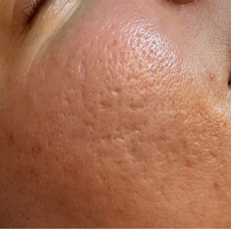 Nærbillede af huden på en kind, der viser tydelige aknear og store porer. Dette billede illustrerer en hudtilstand i ansigtet, som effektivt kan behandles hos Cerix med eksempelvis laser for at reducere ar og forbedre hudens struktur.