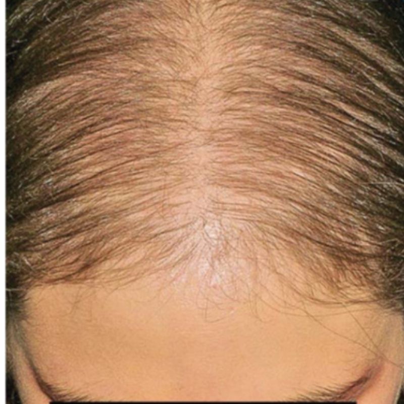 Dette billede viser en næroptagelse af toppen af en persons hoved, hvor der er tydelige tegn på hårtab og udtynding af håret langs skilningen, så hovedbunden er synlig. Hos Cerix tilbyder vi forskellige behandlinger mod hårtab for at genskabe fylde og styrke håret.