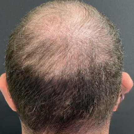 En mands hovedbund set bagfra, der viser tydelige tegn på hårtab og udtynding af hår på kronen. Dette billede fungerer som et "før"-eksempel til en behandling for hårtab, såsom en hårtransplantation, udført af specialisterne hos Cerix.