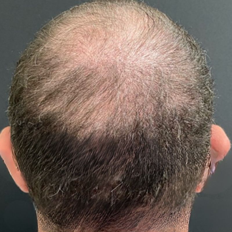 En mands hovedbund set bagfra, der viser tydelige tegn på hårtab og udtynding af hår på kronen. Dette billede fungerer som et "før"-eksempel til en behandling for hårtab, såsom en hårtransplantation, udført af specialisterne hos Cerix.