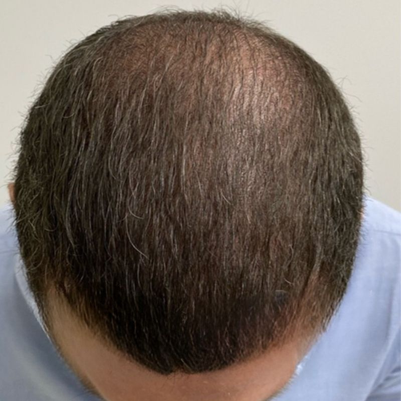 Dette billede fra Cerix viser toppen af en mands hoved, hvor man tydeligt kan se resultatet af en hårtransplantation. Håret på hovedbunden er kort, og man kan se den nye vækst i det behandlede område. Det illustrerer en typisk efter-behandling status for denne type procedure.