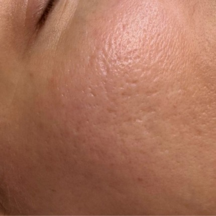 Et nærbillede af en kind med synlige acne ar, store porer og rødme i huden i ansigtet. Cerix tilbyder effektive behandlinger, såsom laser eller Dermapen, til at reducere disse ar og forbedre hudstrukturen for et mere ensartet udseende.