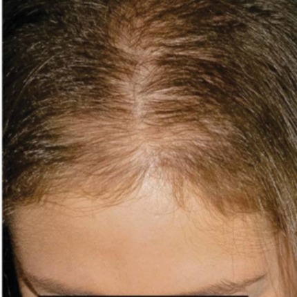 Nærbillede af toppen af et hoved, der viser tydelige tegn på hårtab med udtynding langs den midterste skilning, hvor hovedbunden er synlig. Dette billede illustrerer en tilstand, som Cerix kan afhjælpe med professionelle behandlinger mod hårtab for at styrke håret.