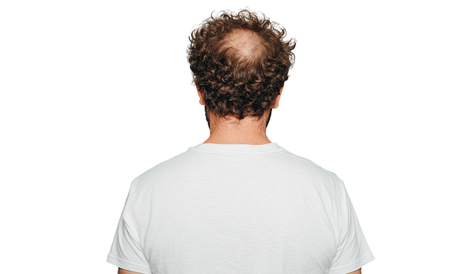 Billede af en mand set bagfra iført en hvid t-shirt. Han har brunt, krøllet hår, men med tydelige tegn på hårtab i form af en begyndende måne på issen. Billedet illustrerer en tilstand, der kan behandles hos Cerix, eksempelvis med en hårtransplantation for at genskabe håret på hovedet.
