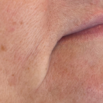 Nærbillede af den nedre del af ansigtet, der viser tydelige rynker ved næse-mund linjen (nasolabiale folder) samt pigmentpletter på huden. Hos Cerix kan disse aldringstegn i ansigtet behandles med for eksempel ikke-permanent filler eller hudforyngende behandlinger for at opnå en glattere hudstruktur.