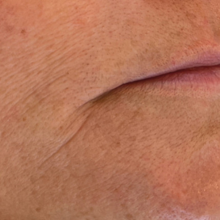 Nærbillede af hud i ansigtet, specifikt området omkring munden og kinden, der viser tydelige tegn på aldring med dybe rynker, linjer og pigmentering. Hos Cerix kan disse problematikker afhjælpes med behandlinger som filler for at udglatte rynkerne.