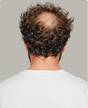 Billede set bagfra af en mands hoved med krøllet, brunt hår, hvor der er tydeligt hårtab og en begyndende måne på issen. Cerix tilbyder professionel behandling af hårtab, herunder hårtransplantation, for at genoprette hårets tæthed på hovedbunden.