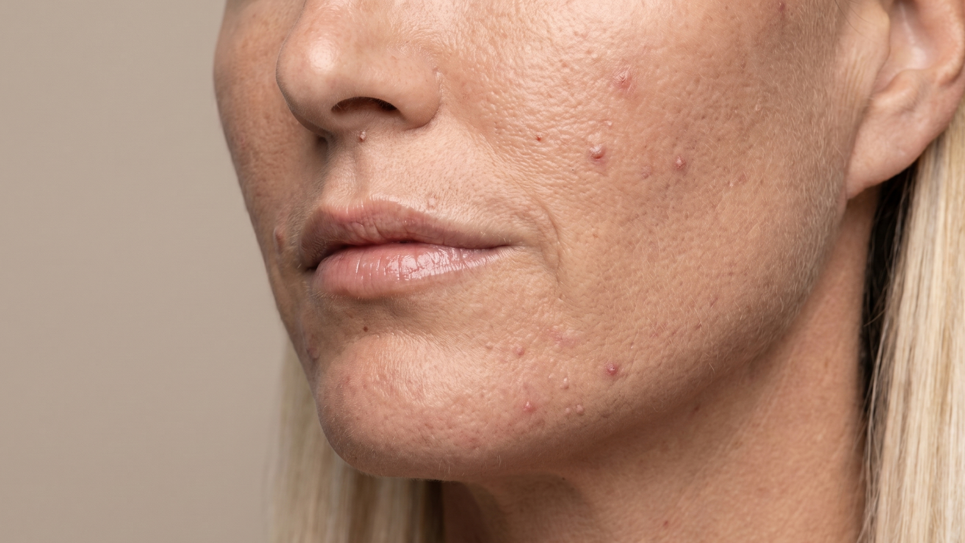 Aknebehandling med kemisk peeling1