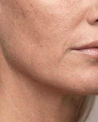 Cosmelan peeling mod Melasma1