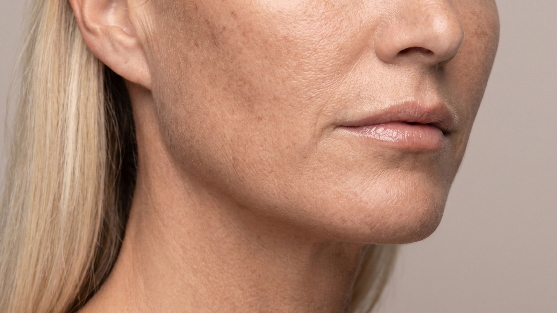 Cosmelan peeling mod Melasma1
