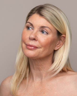IPL behandling mod rosacea1