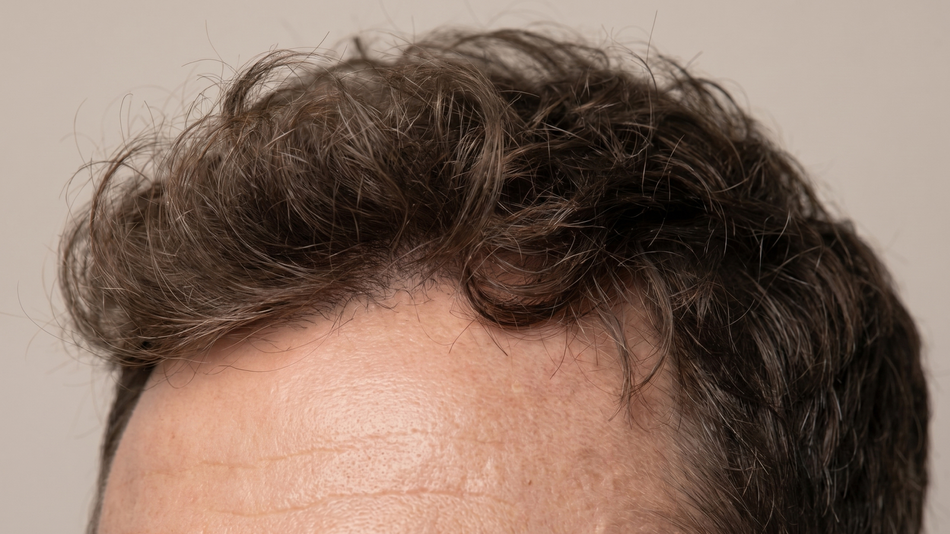 Microneedling med exosomer mod hårtab1