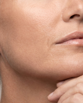 SkinPen microneedling1