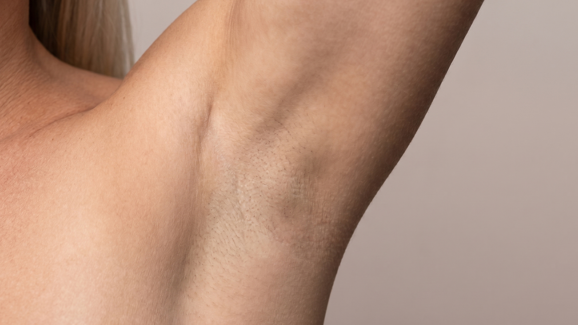 Svedbehandling med botox1